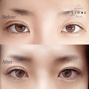 UPWardlash®施術による下がりまつ毛改善のBefore After写真